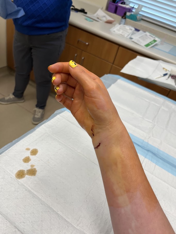 Right hand hovering over medical table. The hand has two punctures at the wrist site, bleeding slightly. The hand is dyed orange with chemicals.