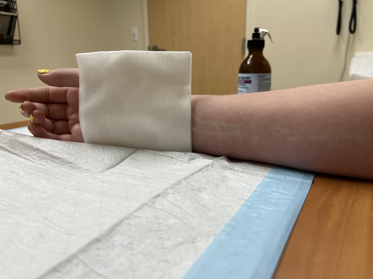 An image of a right hand lying on a table covered in medical paper. The hand's wrist is covered up by a paper towel. The forearm is visible, on which white lines can be seen.